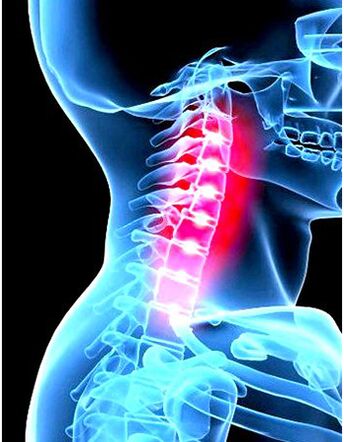 Kliniczny obraz osteochondozy